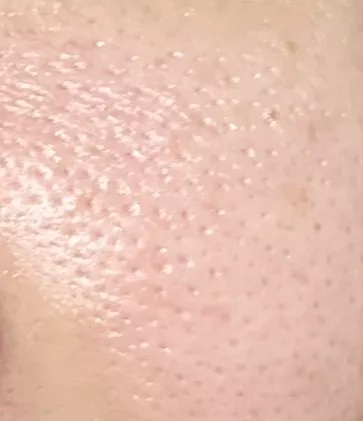 毛孔租大怎麼辦