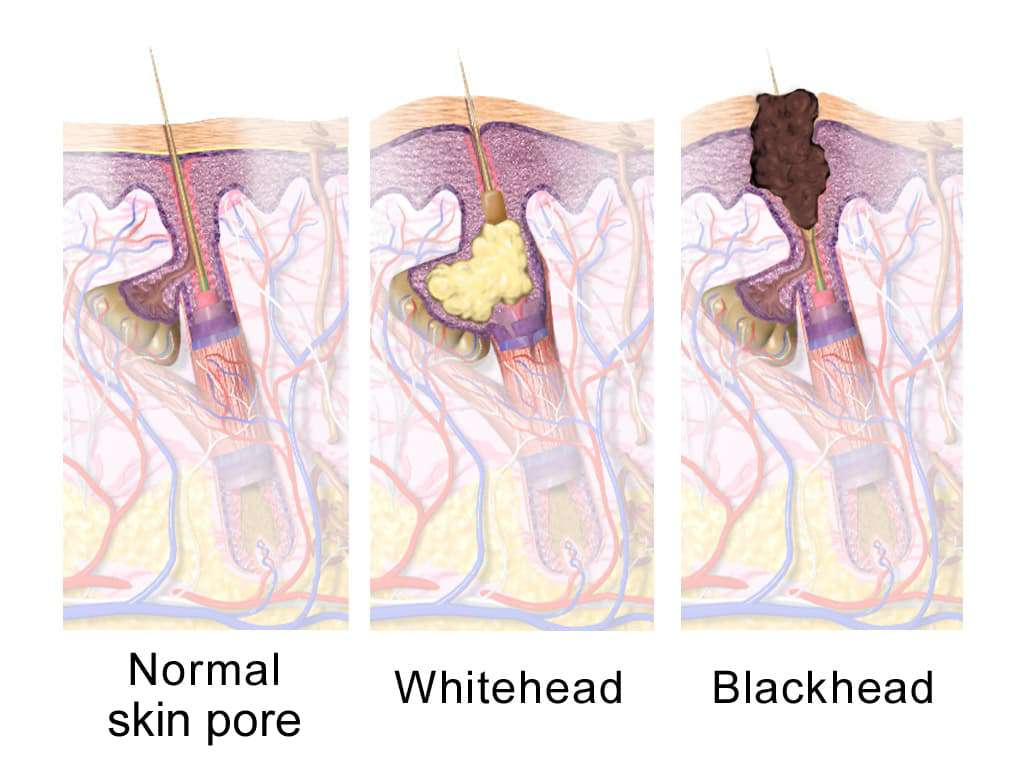 皮膚管理粉刺分為白頭與黑頭