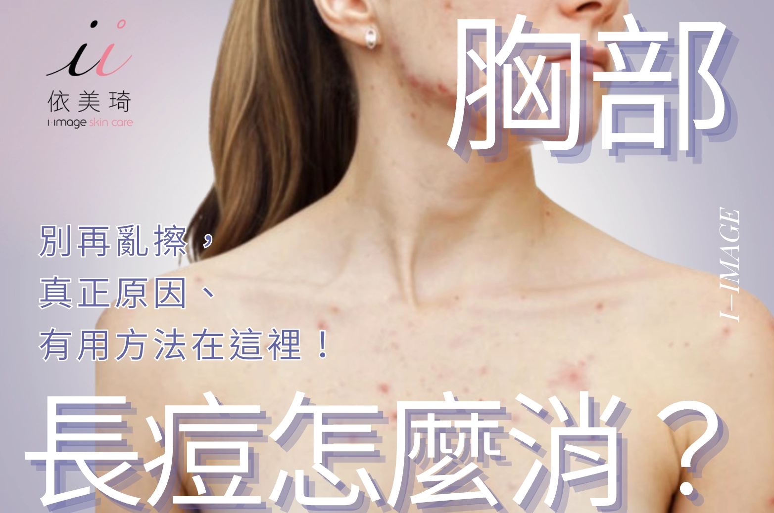 胸前痘痘反覆冒不停，怎麼消？別再亂擦，真正原因、有用方法在這裡！