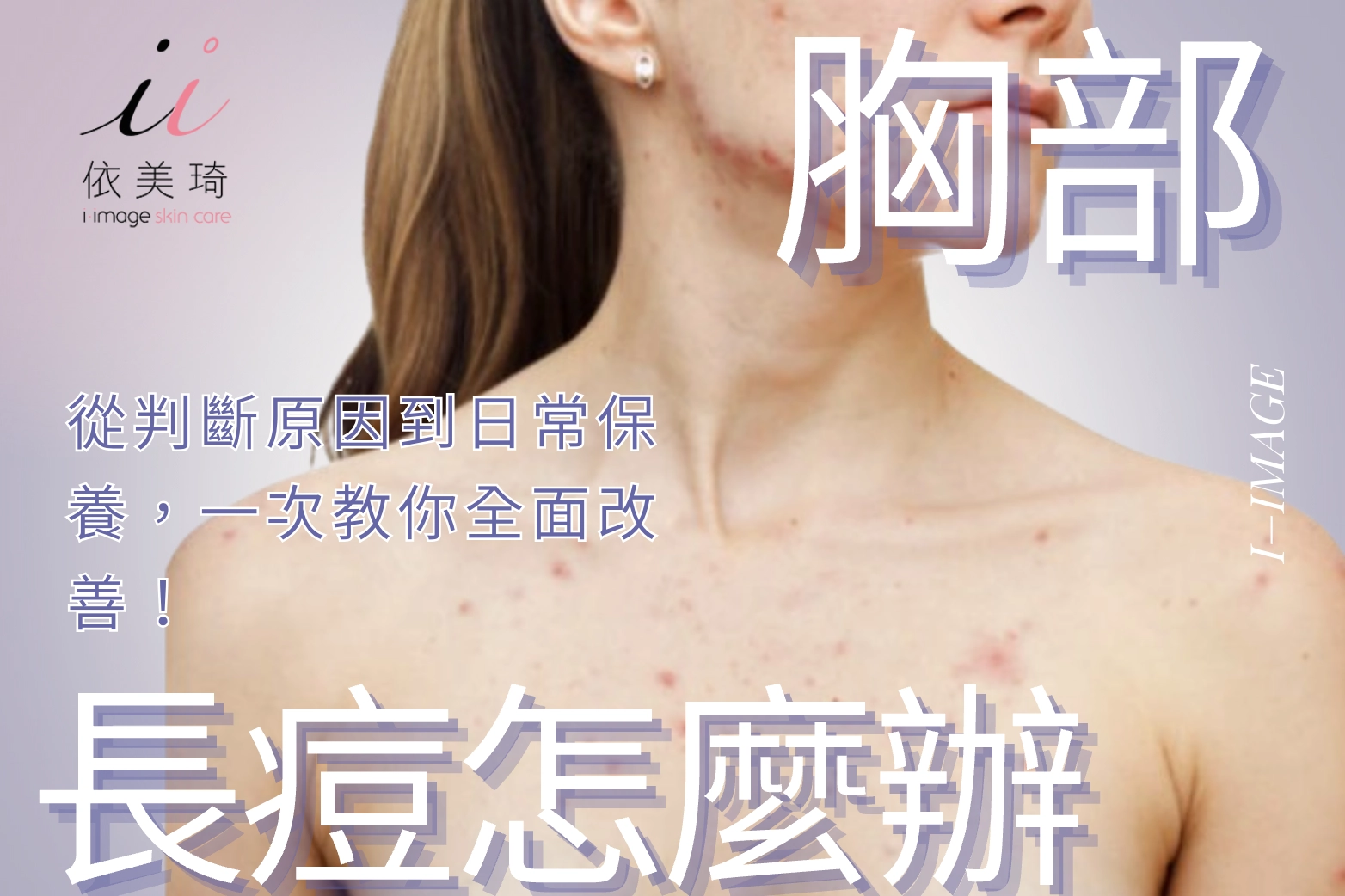 胸口長痘怎麼辦？從判斷原因到日常保養，一次教你全面改善！