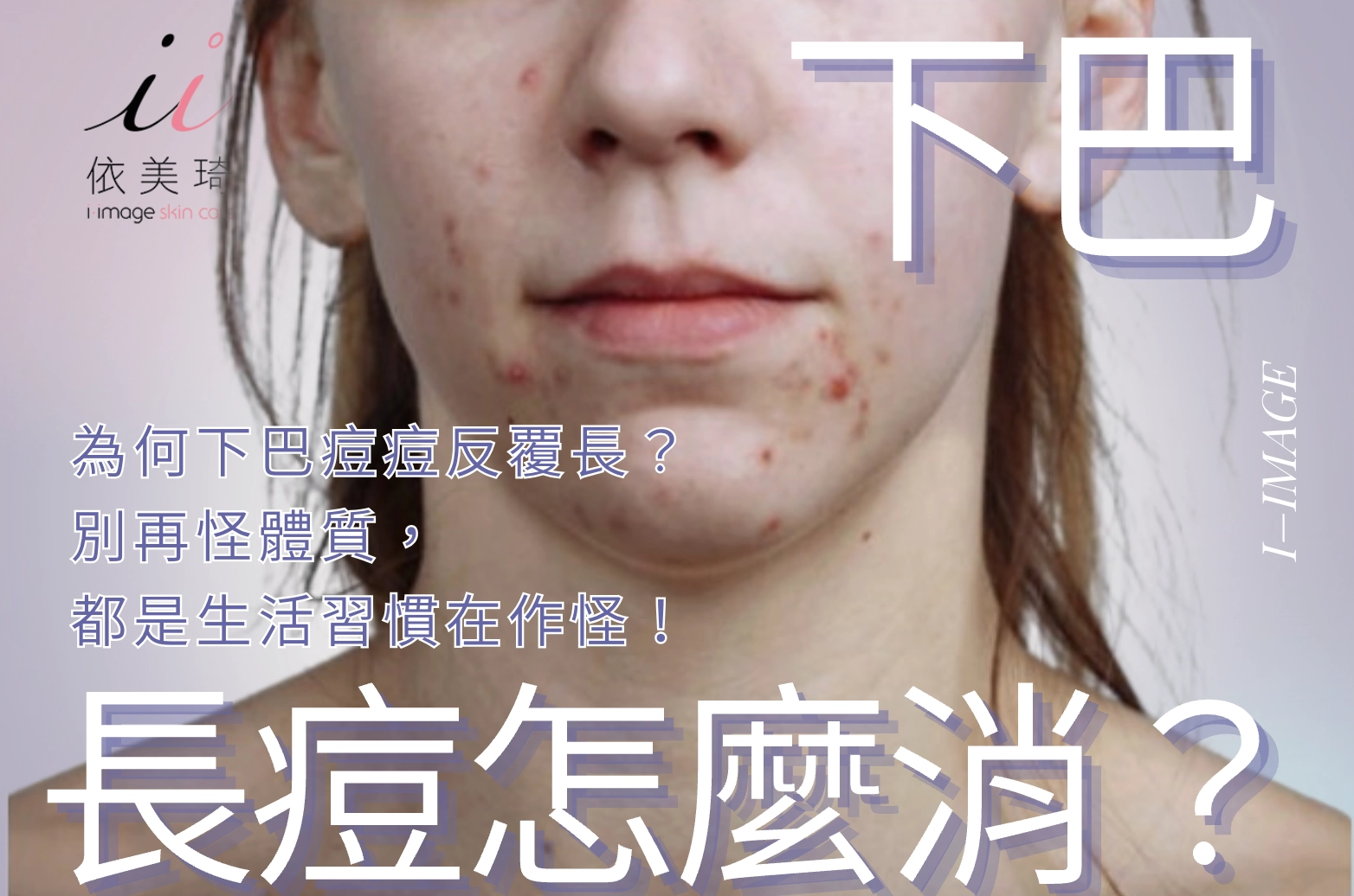 為何下巴痘痘反覆長？口罩痘怎麼消？別再怪體質，都是生活習慣在作怪