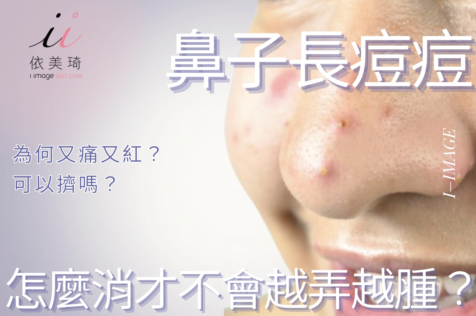 鼻子長痘痘又痛又紅？可以擠嗎？怎麼消才不會越弄越腫？