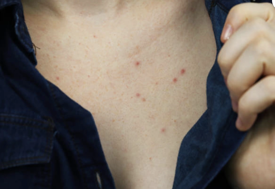 胸口長痘痘怎麼辦？