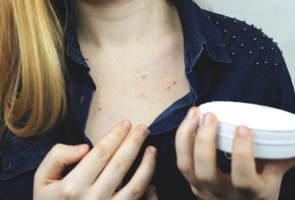 使用含有硫磺、茶樹精油或 BHA（水楊酸）的抗痘產品，有助於降低紅腫與殺菌消炎。