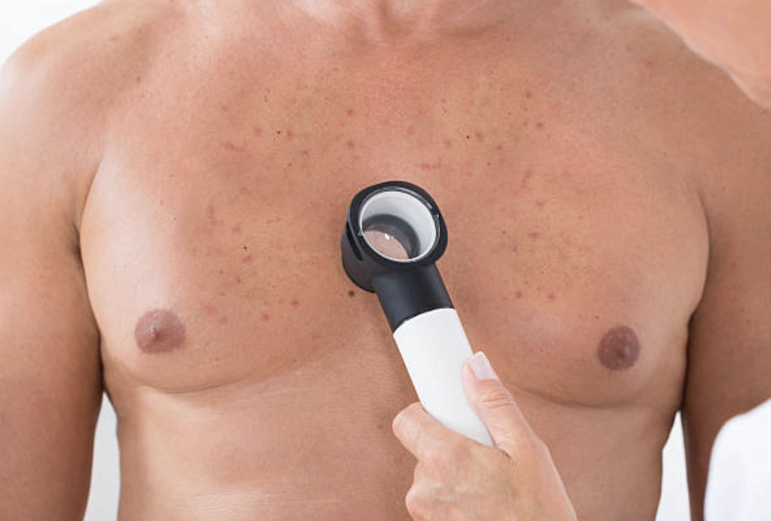 男性的雄性激素會刺激皮脂腺分泌油脂,使胸痘往往比女性更為嚴重