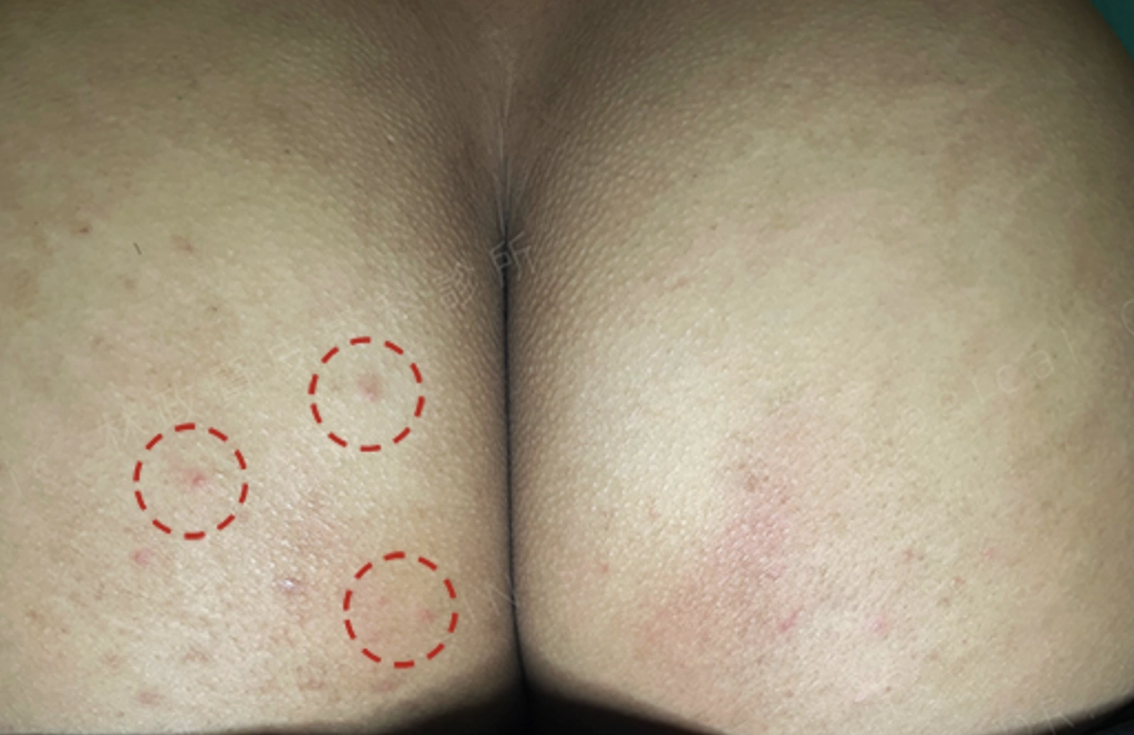 屁股常見的痘痘是毛囊炎