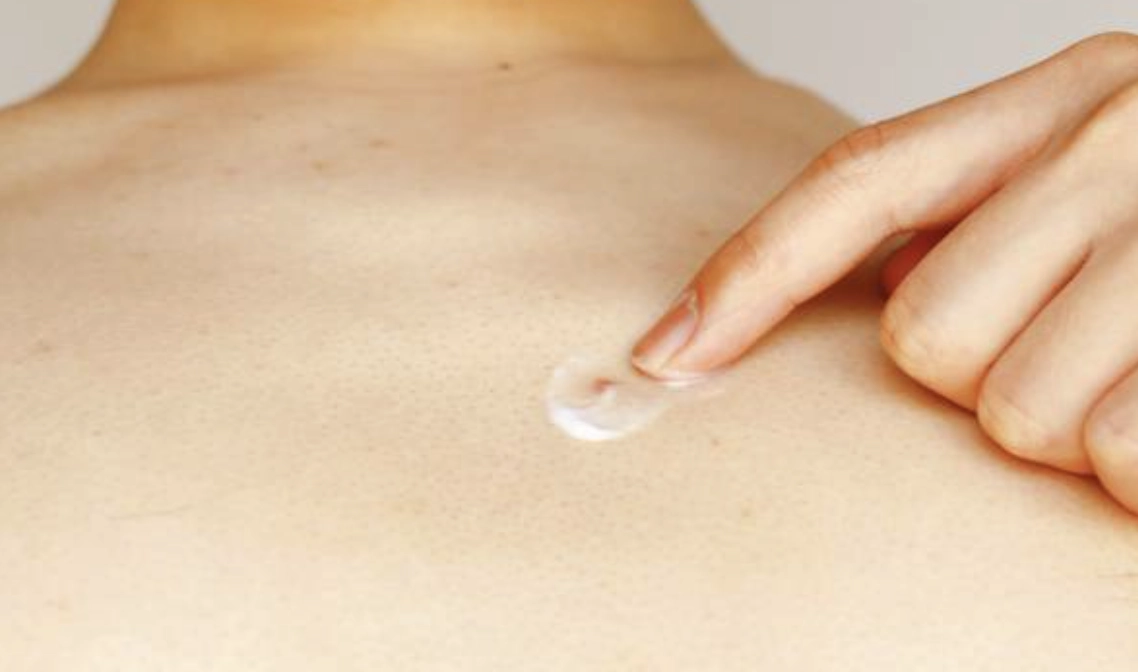 胸痘一般而言多使用外用酸類產品來改善