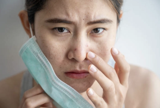 戴口罩摩擦悶住毛孔引發鼻翼長痘痘，稱為口罩型痘痘Maskne
