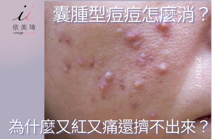 囊腫型痘痘怎麼消？為什麼又紅又痛還擠不出來？